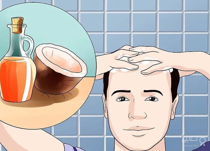 درمان ریزش مو