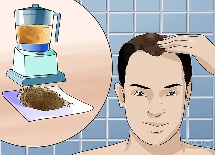 درمان ریزش مو