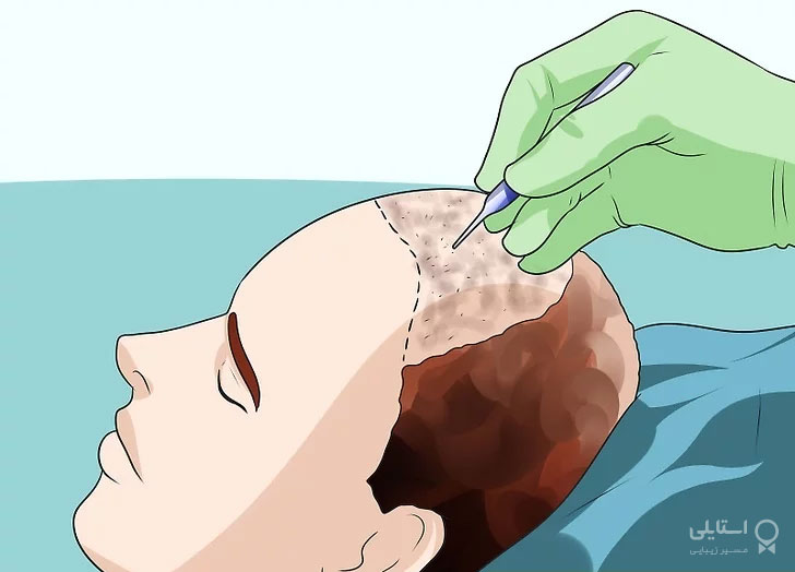 درمان ریزش مو