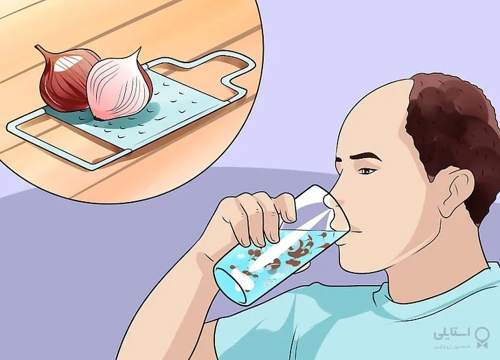 درمان ریزش مو