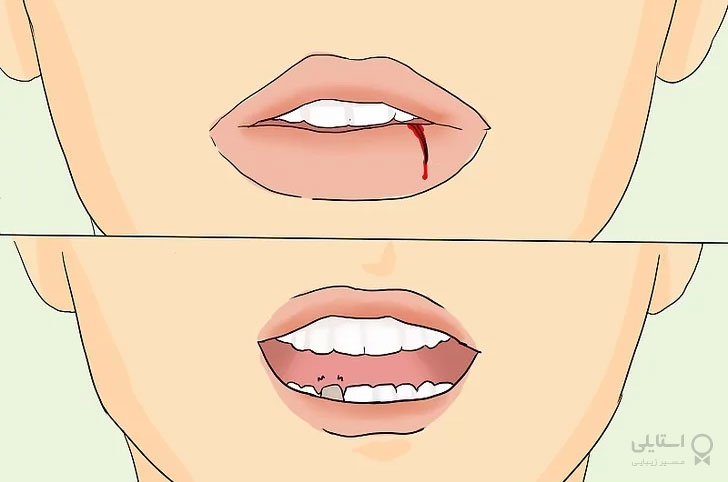 دندان‌ها و لب‌هایتان را پس از آسیب‌دیدگی بررسی کنید