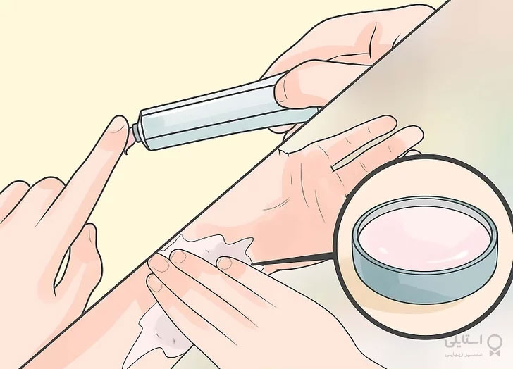 مو زیرپوستی