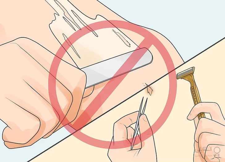 مو زیرپوستی