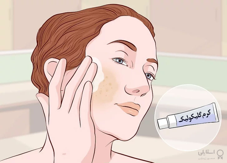 لکهها را با کرمهای گلیکولیک و اسید کوجیک محو کنید