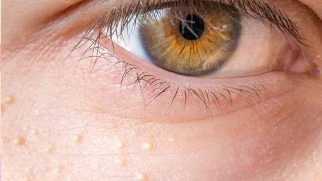 درمان میلیای زیر چشم | جوش‌های سفید زیر پوستی