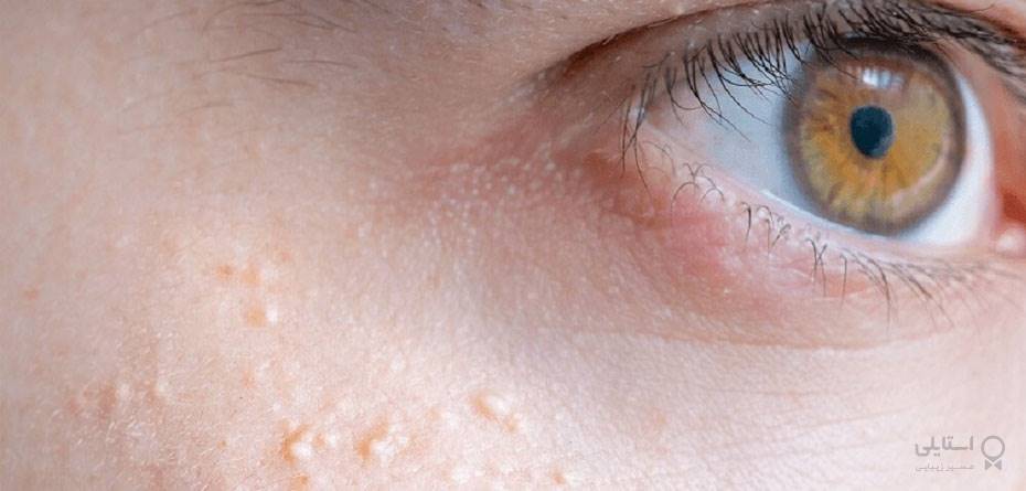 درمان میلیای زیر چشم | جوش‌های سفید زیر پوستی