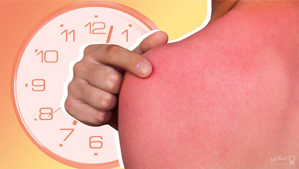 ۱۲ ترفند متخصصان پوست برای درمان آفتاب‌سوختگی